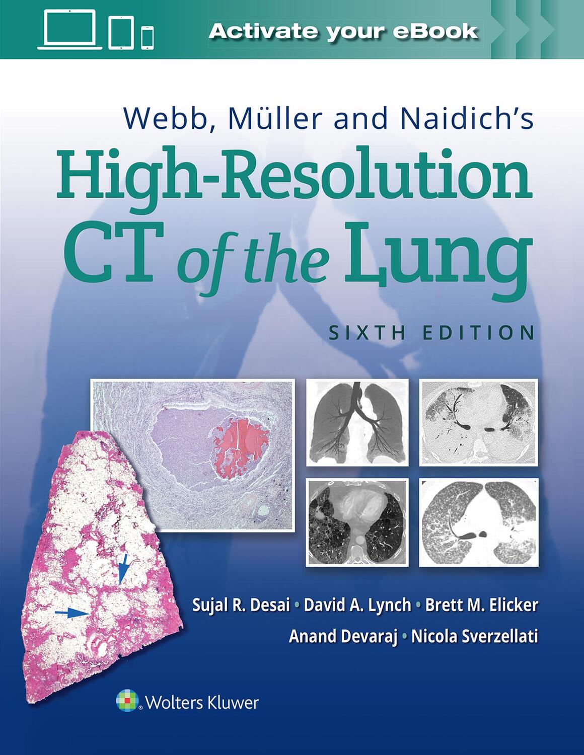 Cover: 9781975144432 | Webb, Muller and Naidich's High Resolution of Lung CT | Desai (u. a.)