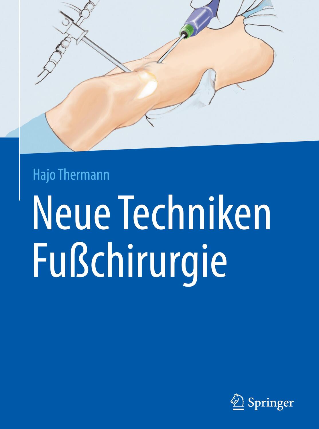 Cover: 9783662527368 | Neue Techniken Fußchirurgie | Hajo Thermann | Buch | Deutsch | 2016