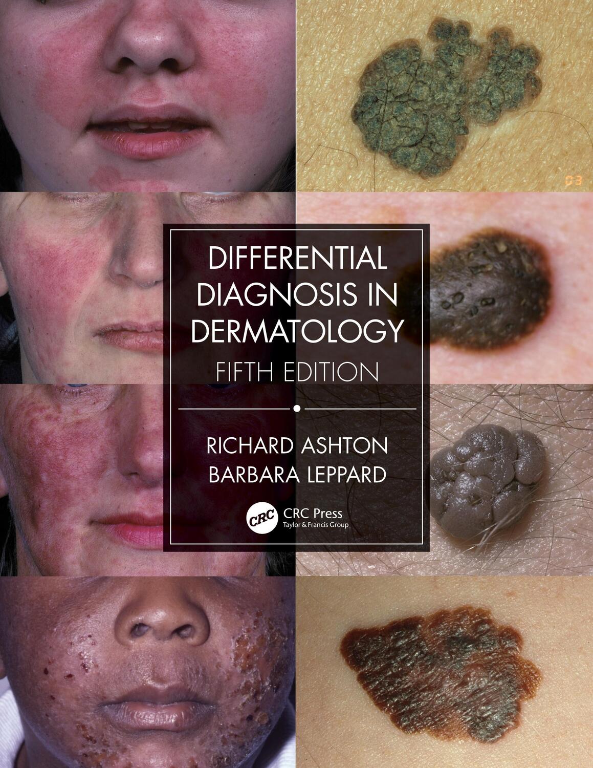Cover: 9780367085971 | Differential Diagnosis in Dermatology | Richard Ashton (u. a.) | Buch