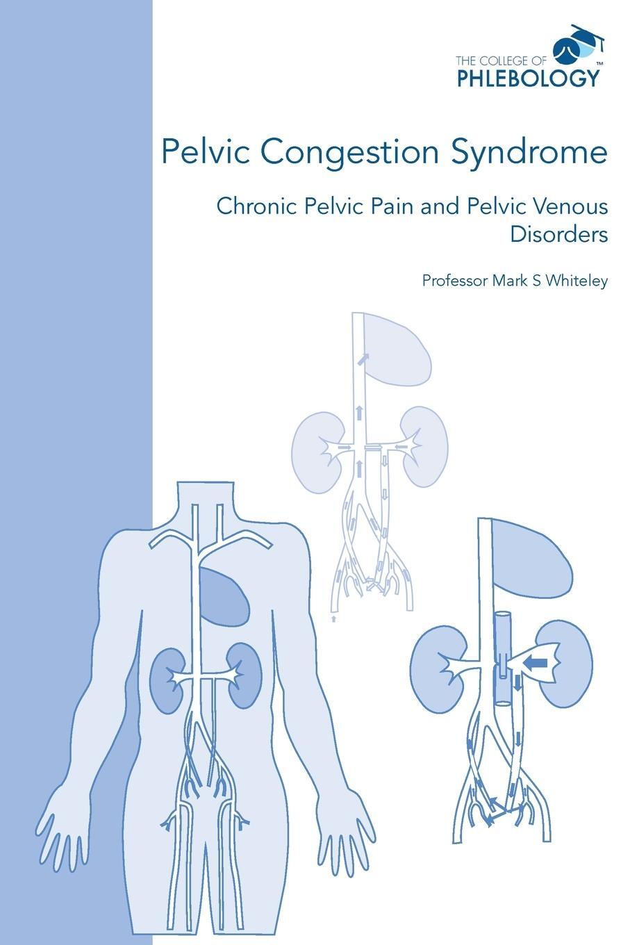 Cover: 9781908586070 | Pelvic Congestion Syndrome - Chronic Pelvic Pain and Pelvic Venous...